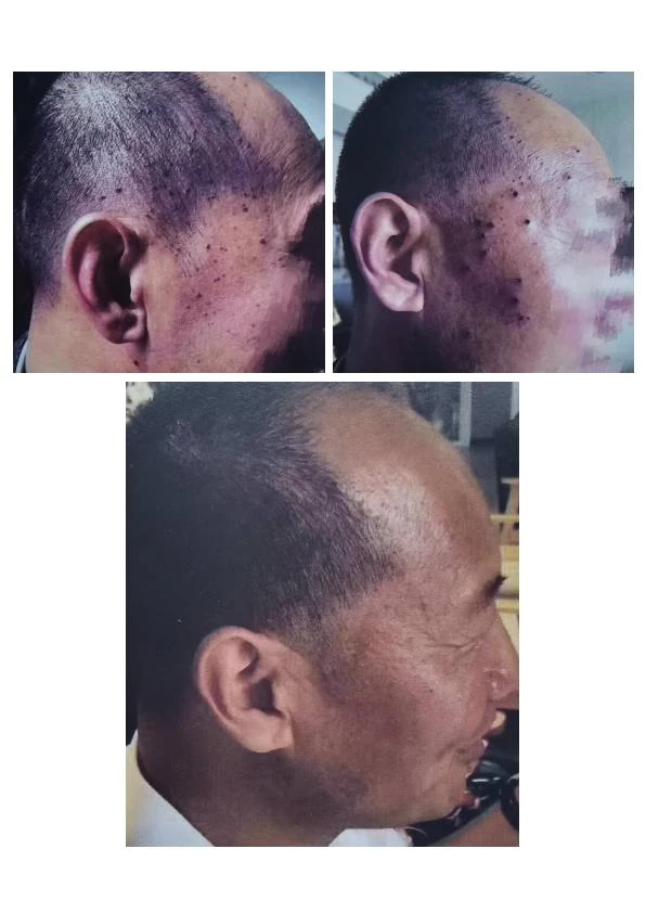 眼周汗管瘤改善记录二