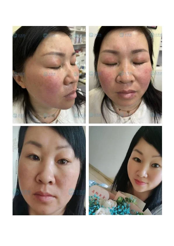 面颊屏障修护对比