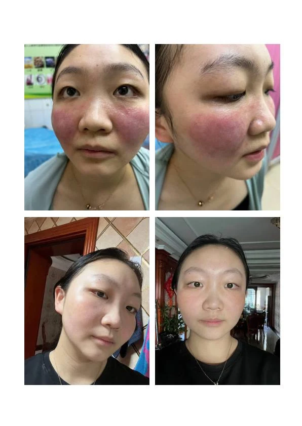 面部屏障修护阶段记录