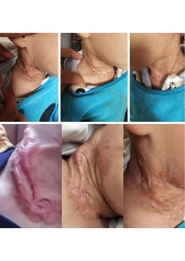 腋下增生疤痕改善记录
