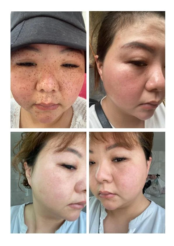 雀斑淡化阶段记录 01