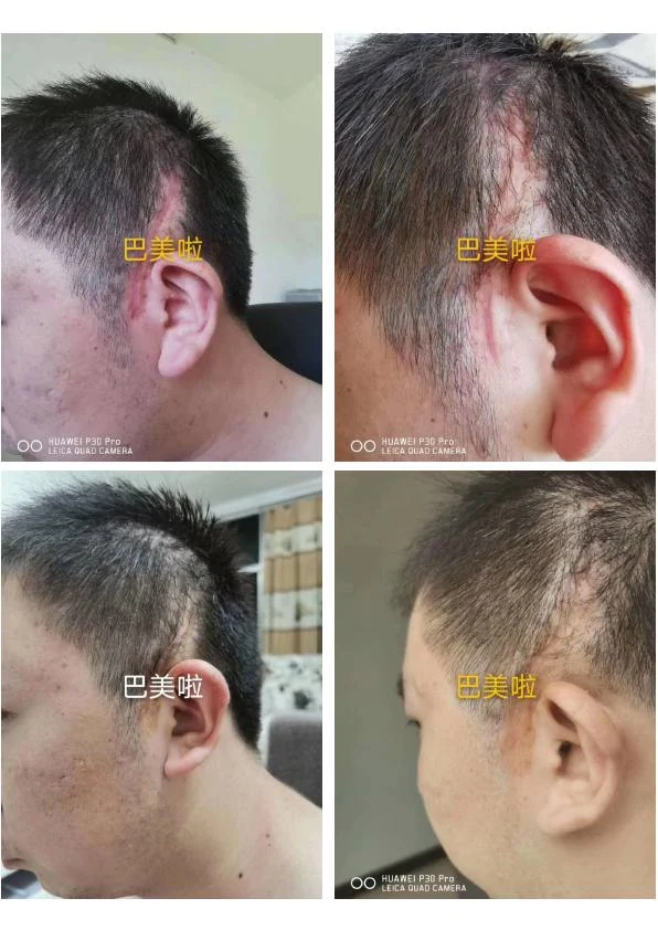 耳部外伤疤痕改善记录