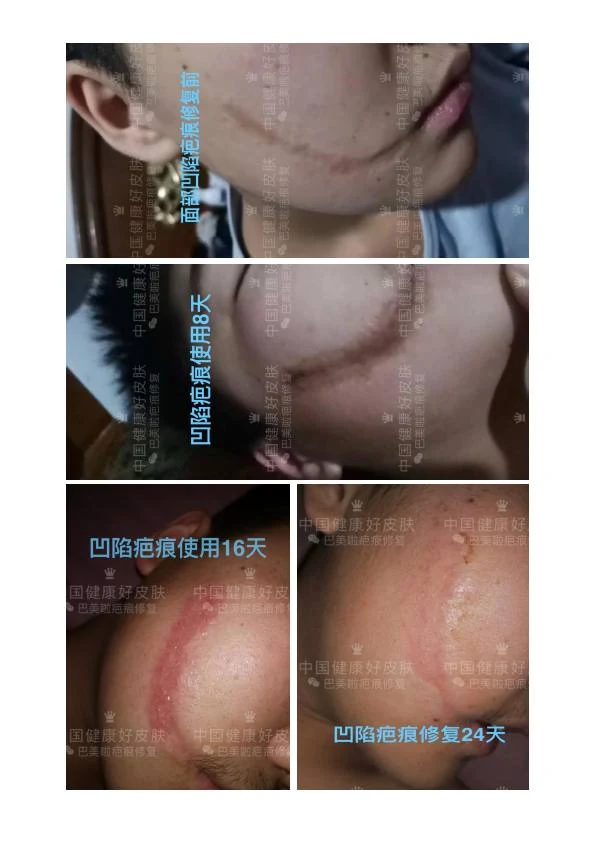 颈部术后疤痕改善记录