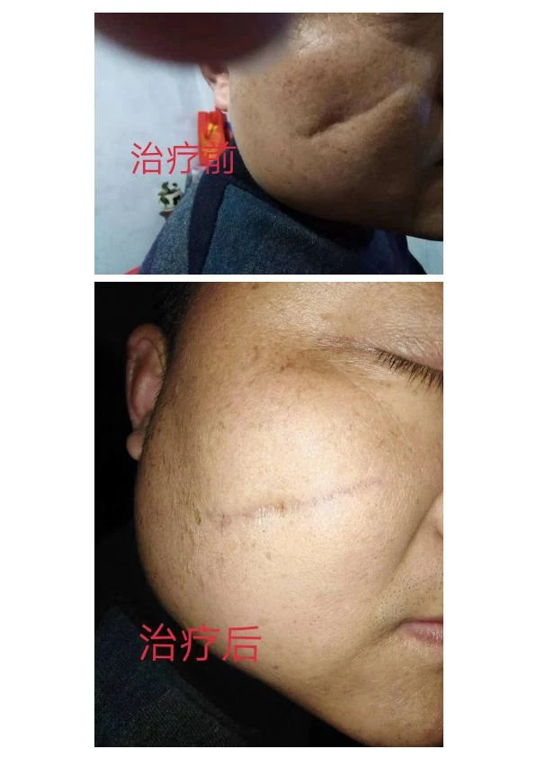 腹部术后疤痕改善记录