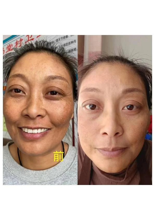 黄褐斑淡化阶段记录 02