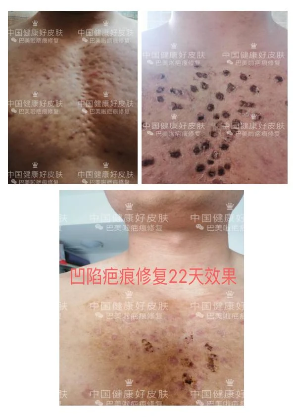 面部凹陷疤修复记录