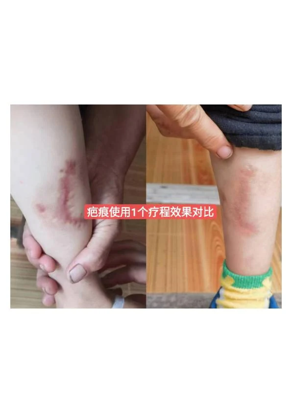 儿童踝部增生疤痕改善记录
