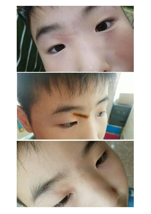 眼周术后疤痕改善记录