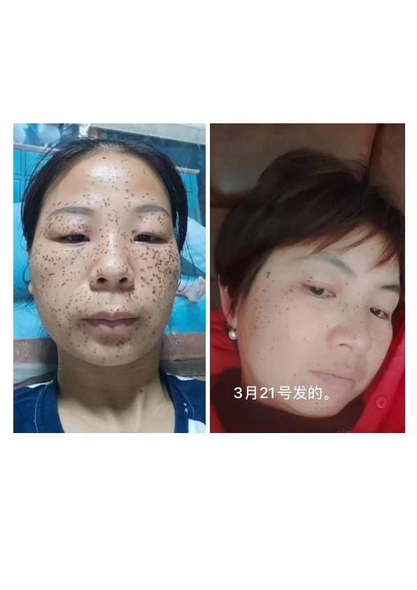 雀斑淡化阶段记录 02