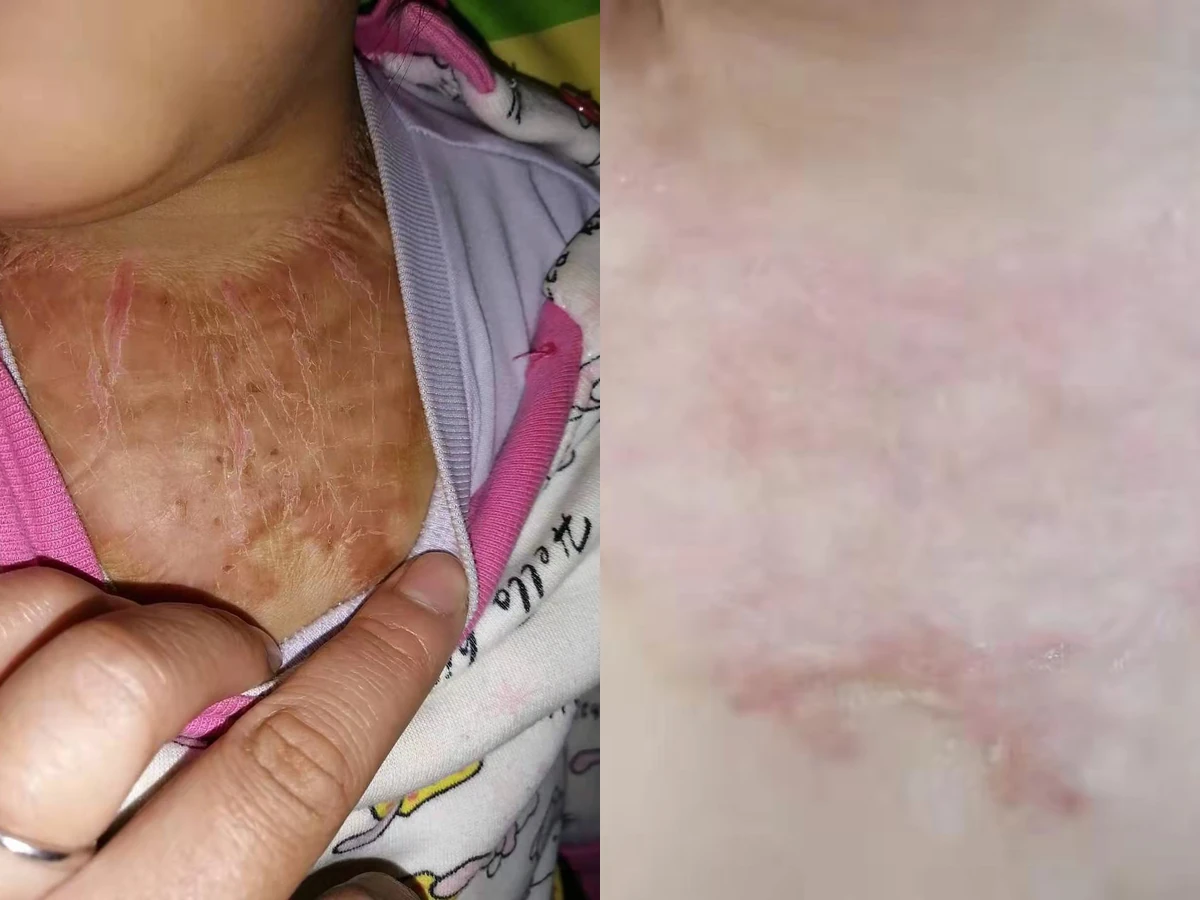 腋下增生疤痕修复对比