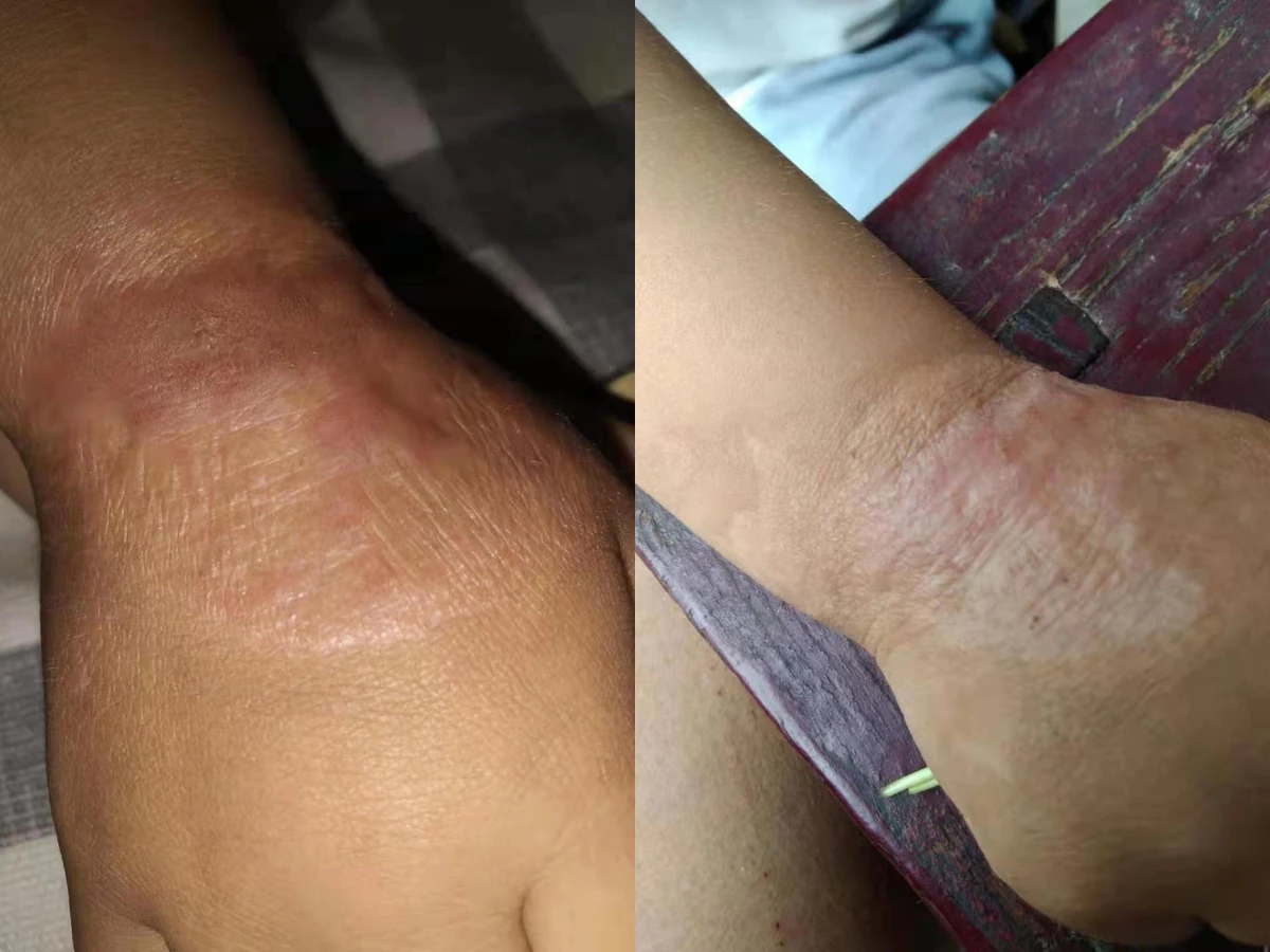 腋下增生疤痕阶段修复