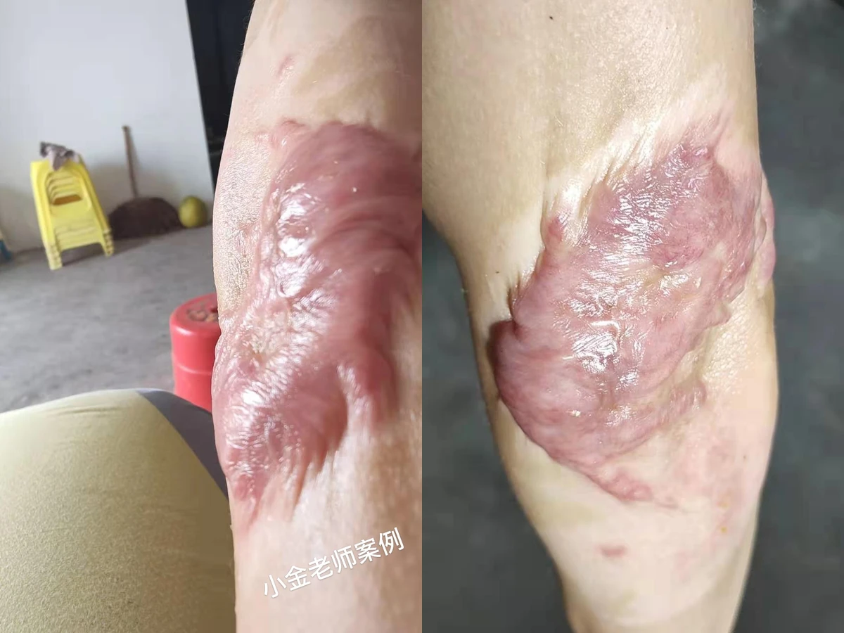 上臂增生疤痕修复对比